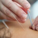 Top 10 Benefits of Acupuncture