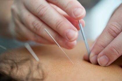 Top 10 Benefits of Acupuncture
